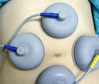 高周波治療器(EMS)の特徴と効果